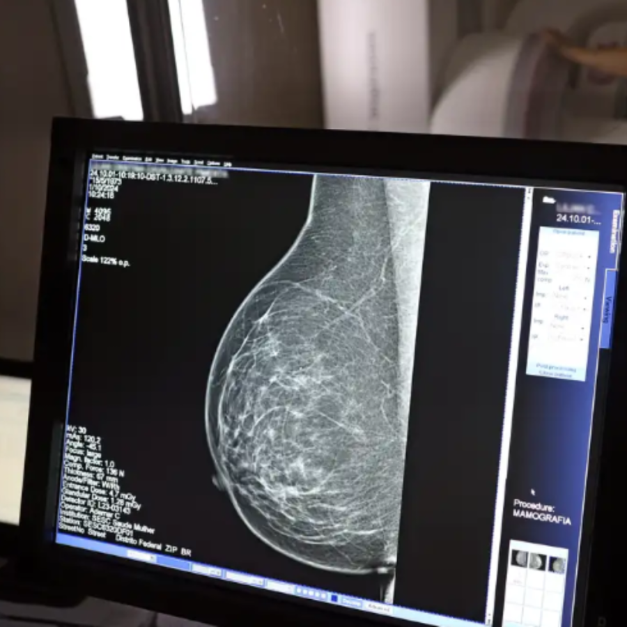 Ministério da Saúde passa a recomendar mamografia a partir dos 40 anos